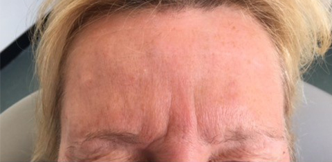 , Anti-wrinkle injections