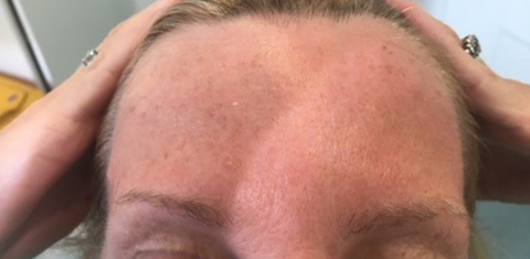 , Anti-wrinkle injections