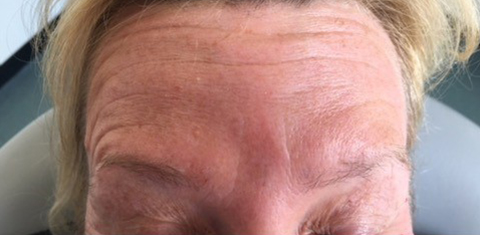 , Anti-wrinkle injections