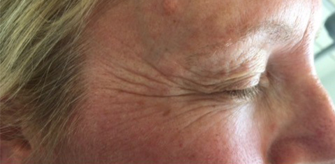 , Anti-wrinkle injections
