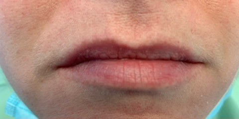 dermal fillers, Dermal Fillers