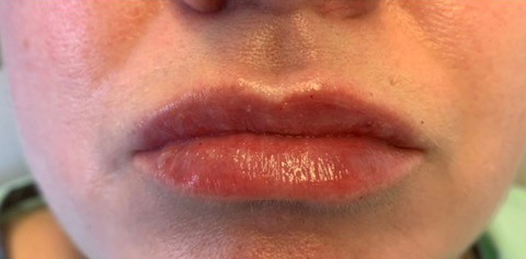 dermal fillers, Dermal Fillers